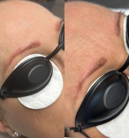 Lézeres eltávolítás Lézeres eltávolítás